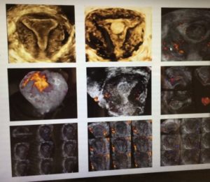 La Dra. Simón presenta su tesis: Un estudio confirma la utilidad de la ecografía 3D en el diagnóstico del cáncer de endometrio