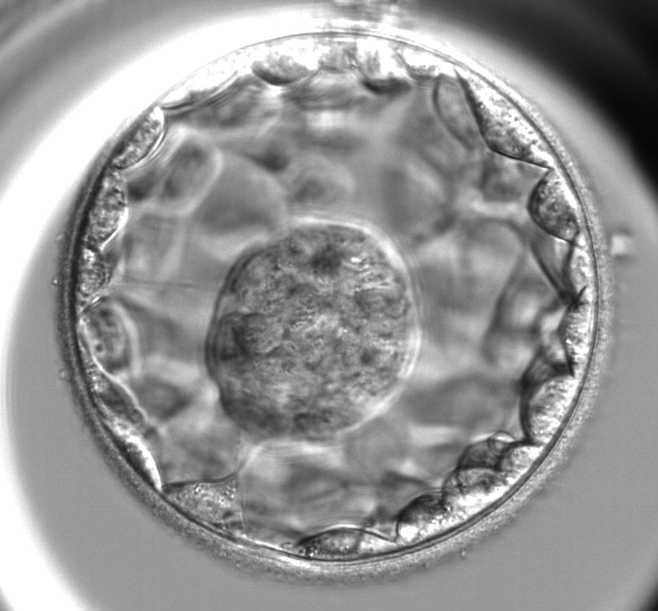 Transferir el embrión en estadio de blastocisto mejora las tasas de embarazo y nacido vivo en los tratamientos de ovodonación