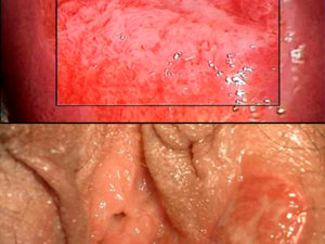 Actualización en colposcopia y patología del tracto genital inferior - 2022