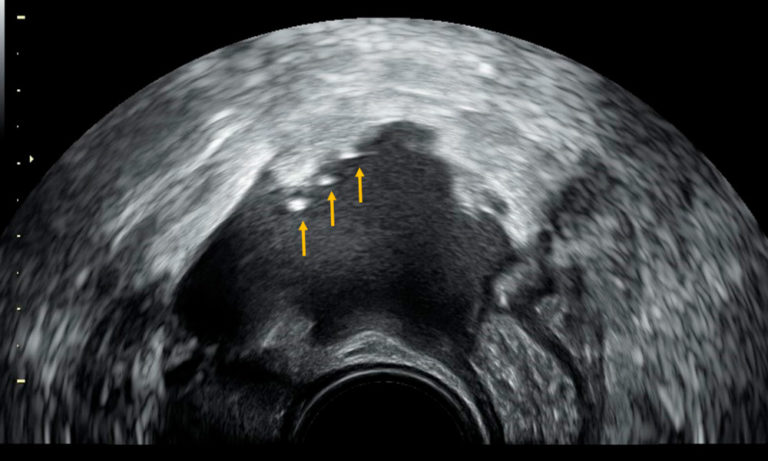 Un estudio confirma la utilidad de la ecografía transvaginal para el diagnóstico de la endometriosis superficial