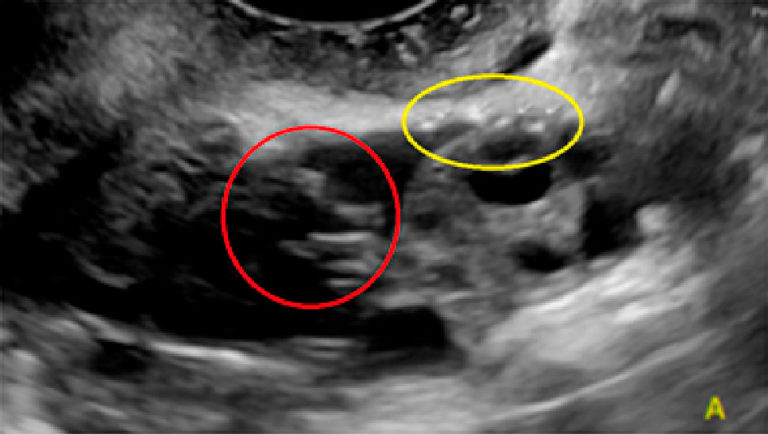 Múltiples lesiones separadas ligeramente abultadas con focos hiperecogénicos (círculo amarillo) y adherencia velamentosa (círculo rojo).