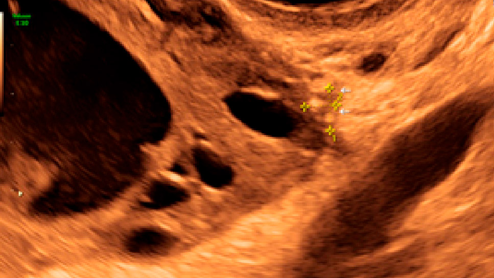 Figure extracted from the article: superficial endometriotic lesions in cluster with honeycomb appearance, convex to the peritoneal surface.