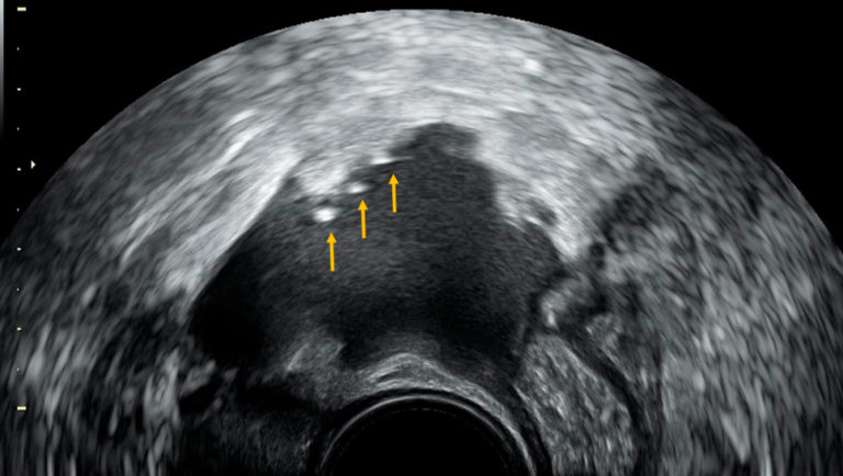 Ecografía transvaginal realizada recientemente en nuestro centro que muestra imágenes compatibles con endometriosis superficial en la superficie del peritoneo.