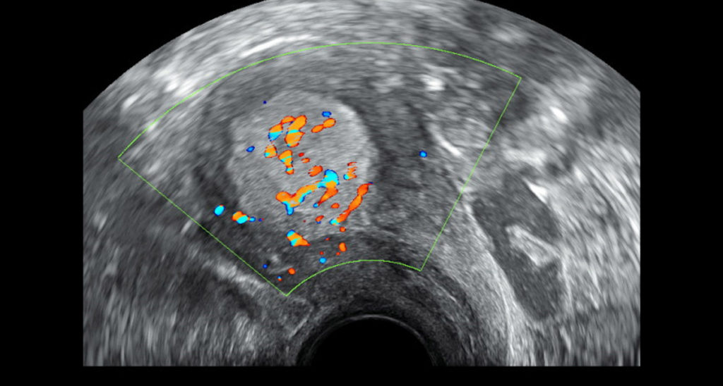 La biopsia del ganglio linfático centinela es clave en el abordaje quirúrgico del cáncer de endometrio en un estadio inicial