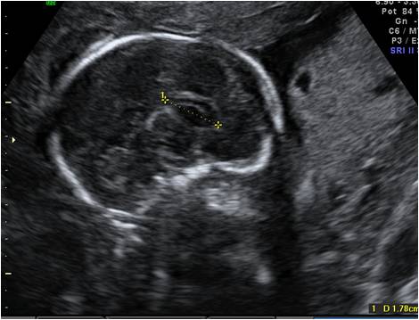 Proponen incluir la evaluación del cuerpo calloso en el cribado ecográfico rutinario del segundo trimestre en gestantes