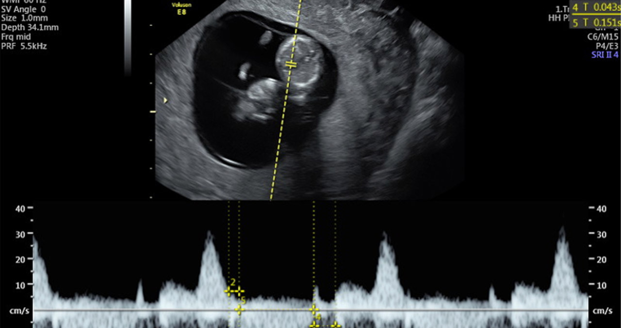 Un estudio aporta nuevos datos para evaluar la función cardiaca fetal en el primer trimestre de gestación