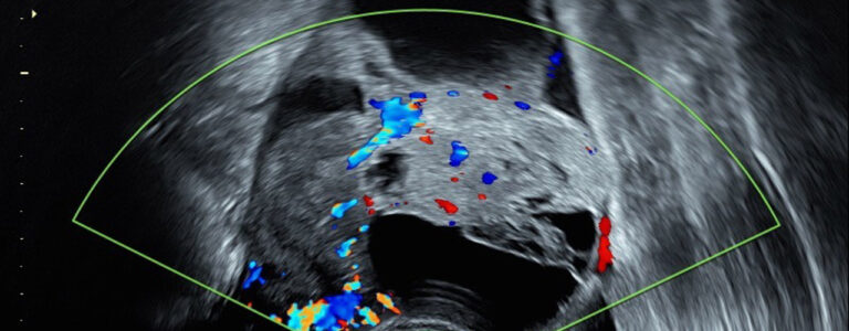 Un estudio multicéntrico internacional valida la detección ecográfica del cáncer de ovario mediante la IA