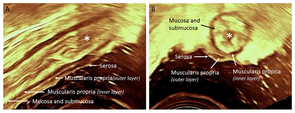 Primer paso hacia la estandarización de la ecografía intraoperatoria en la cirugía de la endometriosis - Yannick Hurni
